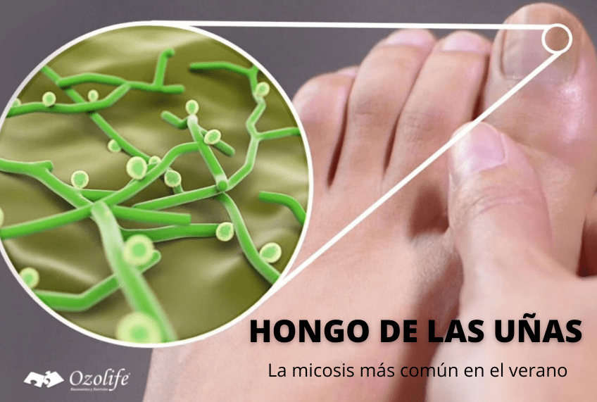 HONGO DE LAS UÑAS