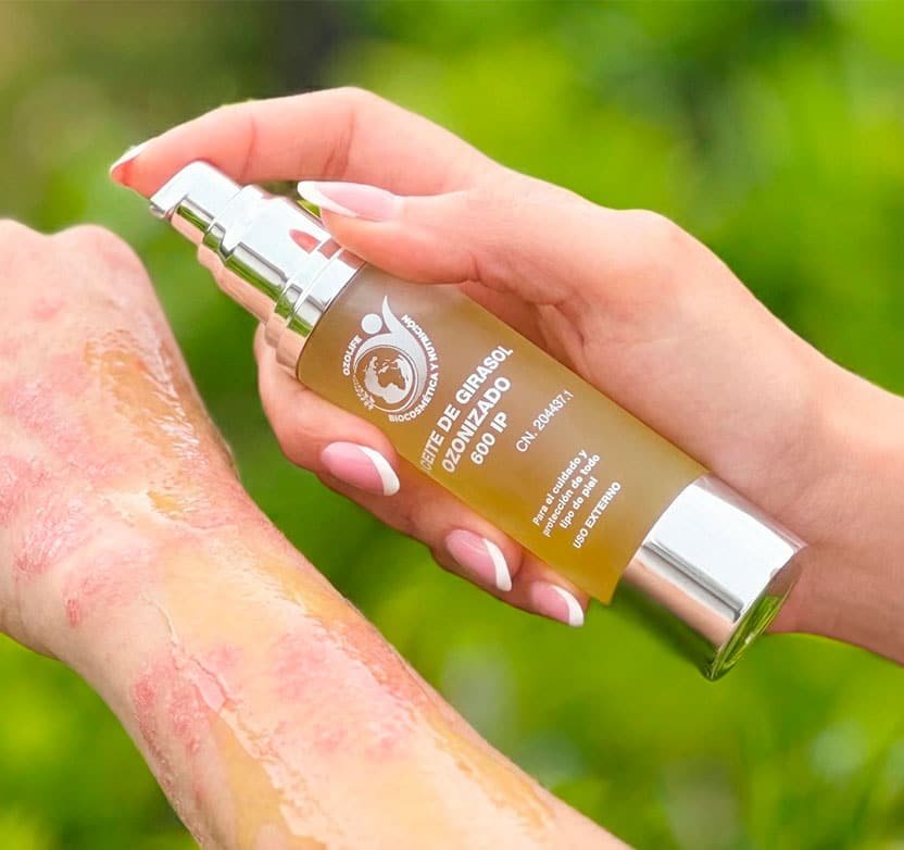 ACEITE OZONIZADO PSORIASIS